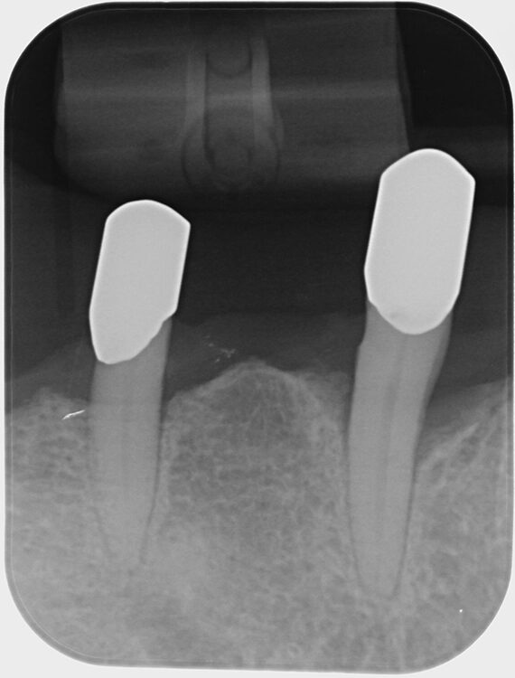 Abb. 6 a–h: Klinische und radiologische Dokumentation 7 Monate nach der AIT und der Applikation von Straumann® Emdogain® an den Zähnen 13 und 23. Die Sondierungstiefen und die parodontal entzündete Wundfläche haben sich im Vergleich zu den initialen Befunden deutlich reduziert. Es lagen keine Sondierungstiefen >5 mm vor. Das bedeutet, es bestand zu diesem Zeitpunkt keine Indikation für ein weiteres ggf. chirurgisches Vorgehen.
