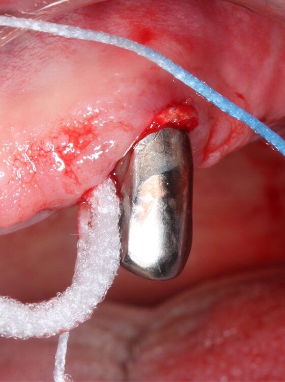 Abb. 4 a–j: Mögliche Variante des schrittweisen klinischen Vorgehens zur Anwendung von Straumann® Emdogain® im Rahmen einer initialen NCPT an Zahn 23. a)Initiale Sondierungstiefe, b) nach der Applikation der Lokalanästhesie erfolgt die subgingivale Instrumentierung mit Ultraschall und c) Pulverwasserstrahlgemischen (AIRFLOW® PLUS Pulver, EMS, Nyon, Schweiz), d) Spülung mit H2O2 3%, e) Spülung mit physiologischer Kochsalzlösung, f) Applikation einer konditionierenden EDTA-Lösung (Straumann® PrefGel®, Straumann Group, Basel, Schweiz), g) Trocknung und Blutstillung durch Einbringen von sterilisiertem Superfloss, h) Zahn 23 vorbereitet für die Applikation von SMP (Straumann® Emdogain®, Straumann Group, Basel, Schweiz), i) Applikation von Straumann® Emdogain®, j) Applikation von Histoacryl® Gewebekleber (B. Braun, Tuttlingen, Deutschland)