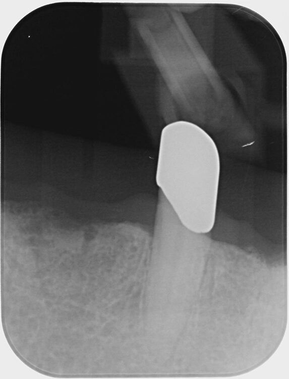 Abb. 6 a–h: Klinische und radiologische Dokumentation 7 Monate nach der AIT und der Applikation von Straumann® Emdogain® an den Zähnen 13 und 23. Die Sondierungstiefen und die parodontal entzündete Wundfläche haben sich im Vergleich zu den initialen Befunden deutlich reduziert. Es lagen keine Sondierungstiefen >5 mm vor. Das bedeutet, es bestand zu diesem Zeitpunkt keine Indikation für ein weiteres ggf. chirurgisches Vorgehen.