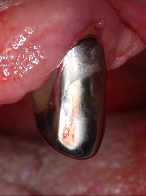 Abb. 4 a–j: Mögliche Variante des schrittweisen klinischen Vorgehens zur Anwendung von Straumann® Emdogain® im Rahmen einer initialen NCPT an Zahn 23. a)Initiale Sondierungstiefe, b) nach der Applikation der Lokalanästhesie erfolgt die subgingivale Instrumentierung mit Ultraschall und c) Pulverwasserstrahlgemischen (AIRFLOW® PLUS Pulver, EMS, Nyon, Schweiz), d) Spülung mit H2O2 3%, e) Spülung mit physiologischer Kochsalzlösung, f) Applikation einer konditionierenden EDTA-Lösung (Straumann® PrefGel®, Straumann Group, Basel, Schweiz), g) Trocknung und Blutstillung durch Einbringen von sterilisiertem Superfloss, h) Zahn 23 vorbereitet für die Applikation von SMP (Straumann® Emdogain®, Straumann Group, Basel, Schweiz), i) Applikation von Straumann® Emdogain®, j) Applikation von Histoacryl® Gewebekleber (B. Braun, Tuttlingen, Deutschland)