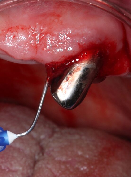 Abb. 4 a–j: Mögliche Variante des schrittweisen klinischen Vorgehens zur Anwendung von Straumann® Emdogain® im Rahmen einer initialen NCPT an Zahn 23. a)Initiale Sondierungstiefe, b) nach der Applikation der Lokalanästhesie erfolgt die subgingivale Instrumentierung mit Ultraschall und c) Pulverwasserstrahlgemischen (AIRFLOW® PLUS Pulver, EMS, Nyon, Schweiz), d) Spülung mit H2O2 3%, e) Spülung mit physiologischer Kochsalzlösung, f) Applikation einer konditionierenden EDTA-Lösung (Straumann® PrefGel®, Straumann Group, Basel, Schweiz), g) Trocknung und Blutstillung durch Einbringen von sterilisiertem Superfloss, h) Zahn 23 vorbereitet für die Applikation von SMP (Straumann® Emdogain®, Straumann Group, Basel, Schweiz), i) Applikation von Straumann® Emdogain®, j) Applikation von Histoacryl® Gewebekleber (B. Braun, Tuttlingen, Deutschland)