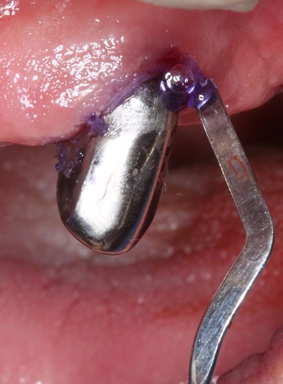 Abb. 4 a–j: Mögliche Variante des schrittweisen klinischen Vorgehens zur Anwendung von Straumann® Emdogain® im Rahmen einer initialen NCPT an Zahn 23. a)Initiale Sondierungstiefe, b) nach der Applikation der Lokalanästhesie erfolgt die subgingivale Instrumentierung mit Ultraschall und c) Pulverwasserstrahlgemischen (AIRFLOW® PLUS Pulver, EMS, Nyon, Schweiz), d) Spülung mit H2O2 3%, e) Spülung mit physiologischer Kochsalzlösung, f) Applikation einer konditionierenden EDTA-Lösung (Straumann® PrefGel®, Straumann Group, Basel, Schweiz), g) Trocknung und Blutstillung durch Einbringen von sterilisiertem Superfloss, h) Zahn 23 vorbereitet für die Applikation von SMP (Straumann® Emdogain®, Straumann Group, Basel, Schweiz), i) Applikation von Straumann® Emdogain®, j) Applikation von Histoacryl® Gewebekleber (B. Braun, Tuttlingen, Deutschland)