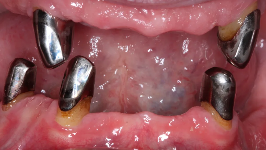 Abb. 6 a–h: Klinische und radiologische Dokumentation 7 Monate nach der AIT und der Applikation von Straumann® Emdogain® an den Zähnen 13 und 23. Die Sondierungstiefen und die parodontal entzündete Wundfläche haben sich im Vergleich zu den initialen Befunden deutlich reduziert. Es lagen keine Sondierungstiefen >5 mm vor. Das bedeutet, es bestand zu diesem Zeitpunkt keine Indikation für ein weiteres ggf. chirurgisches Vorgehen.