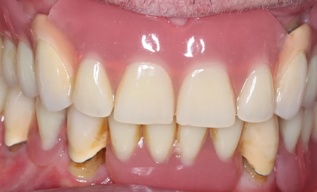 Abb. 6 a–h: Klinische und radiologische Dokumentation 7 Monate nach der AIT und der Applikation von Straumann® Emdogain® an den Zähnen 13 und 23. Die Sondierungstiefen und die parodontal entzündete Wundfläche haben sich im Vergleich zu den initialen Befunden deutlich reduziert. Es lagen keine Sondierungstiefen >5 mm vor. Das bedeutet, es bestand zu diesem Zeitpunkt keine Indikation für ein weiteres ggf. chirurgisches Vorgehen.