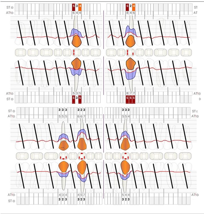 Abb. 6 a–h: Klinische und radiologische Dokumentation 7 Monate nach der AIT und der Applikation von Straumann® Emdogain® an den Zähnen 13 und 23. Die Sondierungstiefen und die parodontal entzündete Wundfläche haben sich im Vergleich zu den initialen Befunden deutlich reduziert. Es lagen keine Sondierungstiefen >5 mm vor. Das bedeutet, es bestand zu diesem Zeitpunkt keine Indikation für ein weiteres ggf. chirurgisches Vorgehen.