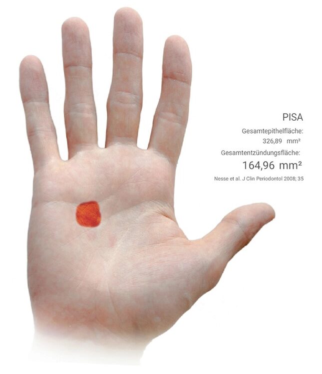 Abb. 6 a–h: Klinische und radiologische Dokumentation 7 Monate nach der AIT und der Applikation von Straumann® Emdogain® an den Zähnen 13 und 23. Die Sondierungstiefen und die parodontal entzündete Wundfläche haben sich im Vergleich zu den initialen Befunden deutlich reduziert. Es lagen keine Sondierungstiefen >5 mm vor. Das bedeutet, es bestand zu diesem Zeitpunkt keine Indikation für ein weiteres ggf. chirurgisches Vorgehen.