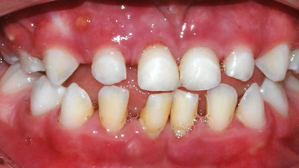 Abb. 1: Das bekannteste Beispiel einer Parodontitis als Manifestation einer seltenen Syndromerkrankung ist das autosomal-rezessiv vererbte Papillon-Lefèvre-Syndrom, das durch eine rasch-progrediente Parodontitis im Kindesalter sowie durch palmoplantare Hyperkeratosen der Hände und Füße gekennzeichnet ist; ursächlich sind Mutationen im CTSC-Gen.