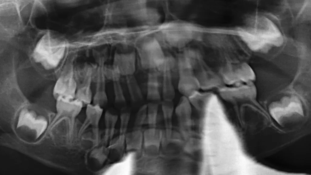 Abb. 1: Das bekannteste Beispiel einer Parodontitis als Manifestation einer seltenen Syndromerkrankung ist das autosomal-rezessiv vererbte Papillon-Lefèvre-Syndrom, das durch eine rasch-progrediente Parodontitis im Kindesalter sowie durch palmoplantare Hyperkeratosen der Hände und Füße gekennzeichnet ist; ursächlich sind Mutationen im CTSC-Gen.