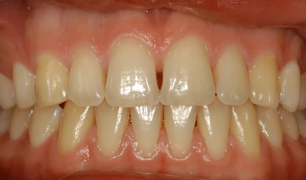 Abb. 2: Basierend auf der schweren Parodontitis im Alter von 3 Jahren diagnostizierte der behandelnde Zahnarzt das Papillon-Lefèvre-Syndrom (s. Abb. 1). Die Therapie bestand aus Extraktionen von Milchzähnen, einem strikten Biofilmmanagement und wiederholten subgingivalen Instrumentierungen mit adjuvanter Antibiotikatherapie (Amoxicillin und Metronidazol). Im Alter von 21 Jahren zeigt sich der Betroffene als parodontal gesund.