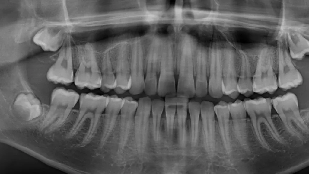 Abb. 2: Basierend auf der schweren Parodontitis im Alter von 3 Jahren diagnostizierte der behandelnde Zahnarzt das Papillon-Lefèvre-Syndrom (s. Abb. 1). Die Therapie bestand aus Extraktionen von Milchzähnen, einem strikten Biofilmmanagement und wiederholten subgingivalen Instrumentierungen mit adjuvanter Antibiotikatherapie (Amoxicillin und Metronidazol). Im Alter von 21 Jahren zeigt sich der Betroffene als parodontal gesund.