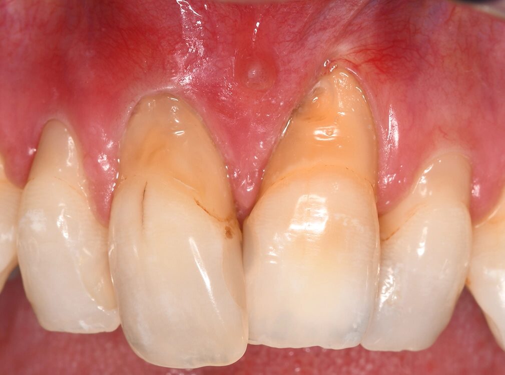 Abb. 4: Intraorale Ansicht des 12-jährigen Patienten. Auch die häusliche Zahnreinigung ist mangelhaft.