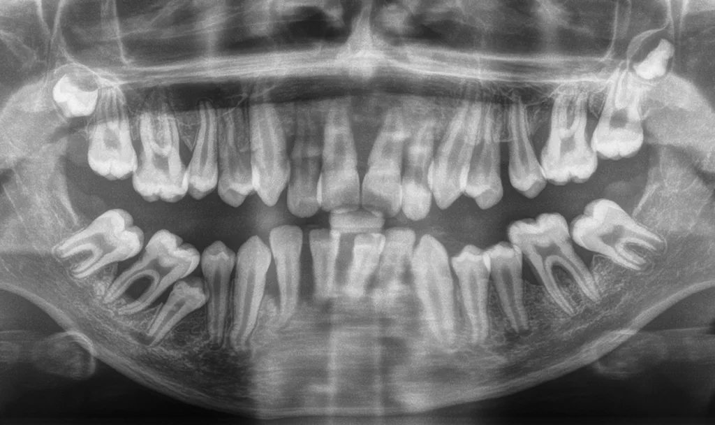 Abb. 5: Patientin mit parodontalem Ehlers-Danlos-Syndrom mit 28 Jahren. Hauptsymptom ist eine rasch progrediente Parodontitis. Die Parodontitis manifestiert sich teilweise schon im Milchgebiss, teilweise erst während der Pubertät und führt unbehandelt in wenigen Jahren zur Zahnlosigkeit.