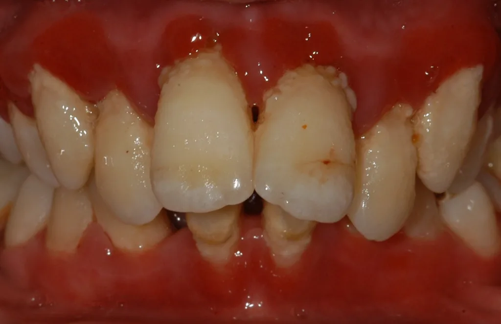 Abb. 6: Die Patientin mit parodontalem Ehlers-Danlos-Syndrom zeigt zusätzlich zur Parodontitis den typischen Gingivatyp, das komplette Fehlen der befestigten Gingiva. Dieser Gingivatyp wurde bisher bei allen Patientinnen und Patienten mit genetisch bestätigtem parodontalem EDS diagnostiziert und gilt somit als pathognomonisch.