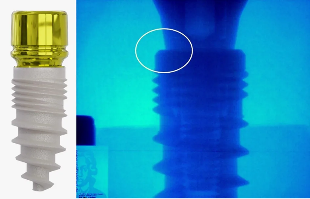Abb. 1: Die (R)Evolution Systeme verfügen über einen bakteriendichten Innenkonus von 9,5°. Beim zweiteiligen (R)Evolution System ist der inzwischen goldanodisierte, sogenannte Shuttle-Insertions-, Stopp-(scanbares-)Abformungs-Tool, chirurgische Verschlussschraube und Gingivaformer in einem.