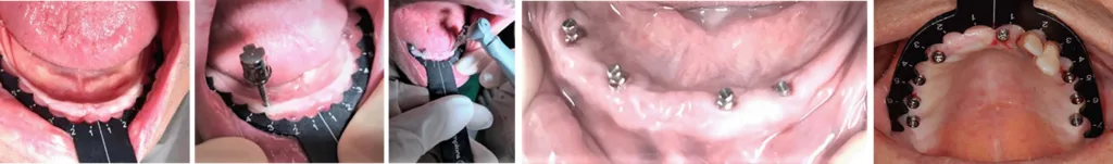 Abb. 4: Champions-Guides sind wieder aufbereitbare und sterilisierbare, biegbare und als Navigationshilfe empfehlenswerte Schablonen, um gerade bei „großen Fällen“ Implantatpositionen prä- (am Gipsmodell) oder intraoperativ ermitteln zu können