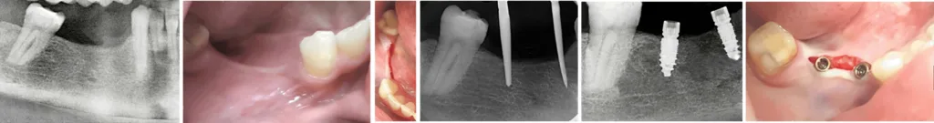 Abb. 5: Anwendung der MIMI-II-Technik bei schmalen Kieferkämmen.