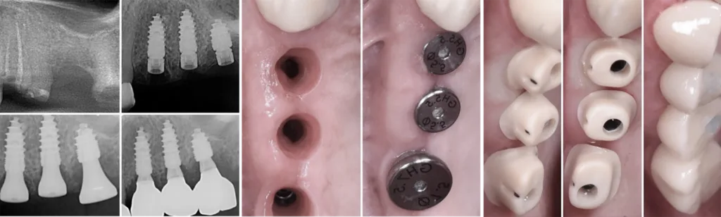 Abb. 5: Sofortimplantationen (MIMI-0), wie hier zu sehen, sind mit dem Champions System sowohl in der Chirurgie als auch in der Prothetik problemlos und ästhetisch optimal möglich.