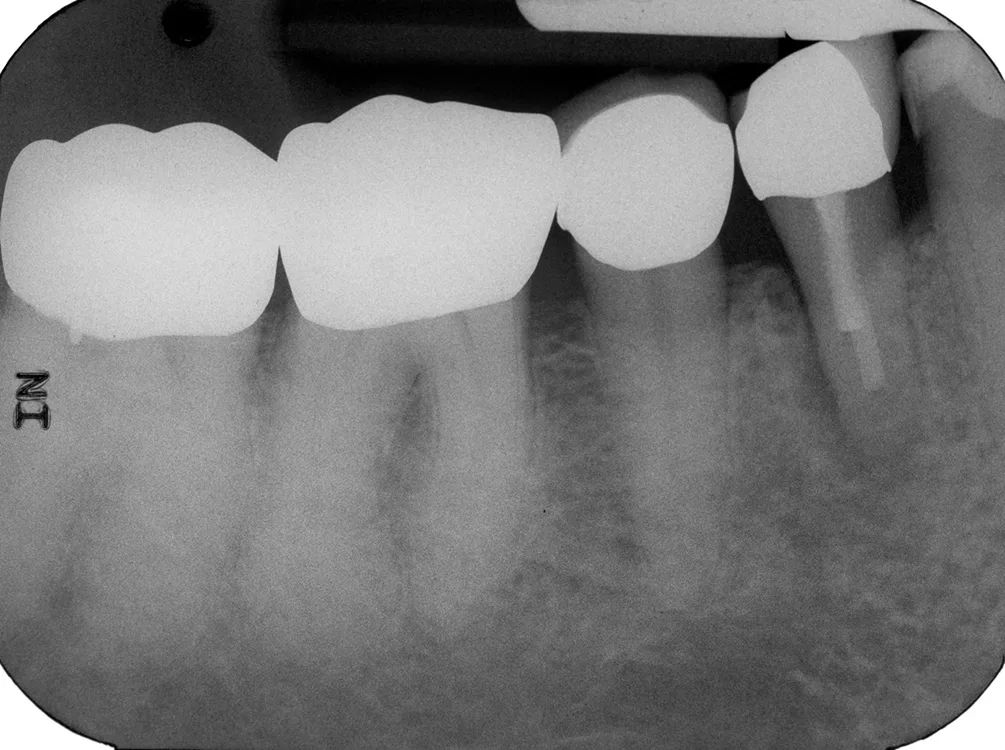 Abb. 1a: Verdacht auf Längsfraktur des Zahnes 34 bei einer 83-jährigen Patientin.