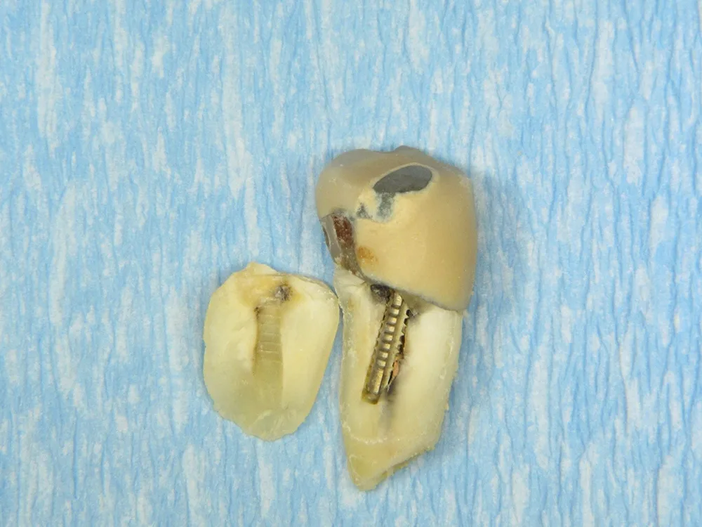 Abb. b: Der extrahierte Zahn bestätigte den Verdacht.