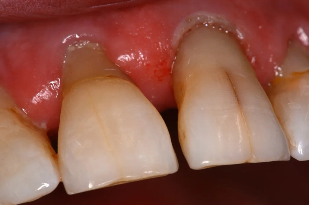 Abb. 2: Deutlich erkennbare Schmelzrisse an den Zähnen 11 und 21 bei einem 78-jährigen Patienten.