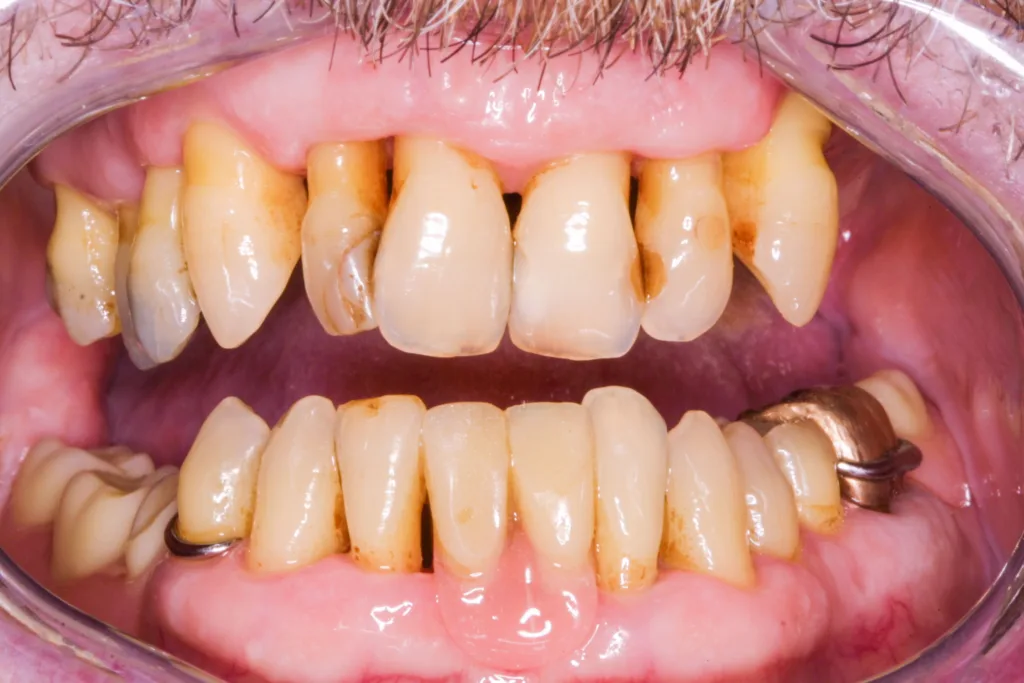 Intraorale Situation bei einem 70-jährigen Patienten: Parodontitis, eingesunkener Prothesensattel (li. Bildseite) bei insgesamt guter Mundhygiene