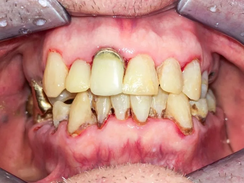 Kein Einzelfall in einer Pflegesituation: Plaqueansammlung, (Wurzel-)karies, Gingivitis/Parodontitis, Mundtrockenheit bei einem 82-jährigen Patienten..