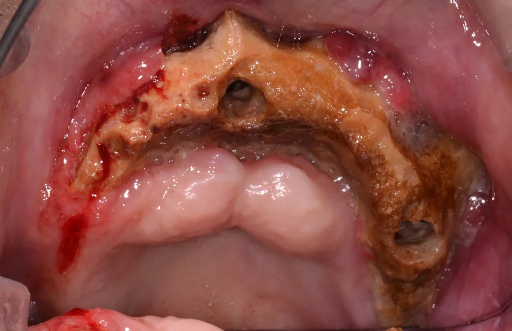 Abb. 1a und b: Ausgangssituation: Die Aufsichtsbilder zeigen den zahnlosen Ober- und Unterkiefer. Deutlich sichtbar sind die nekrotischen Knochenareale und die Entzündungen im Bereich der Gingiva.