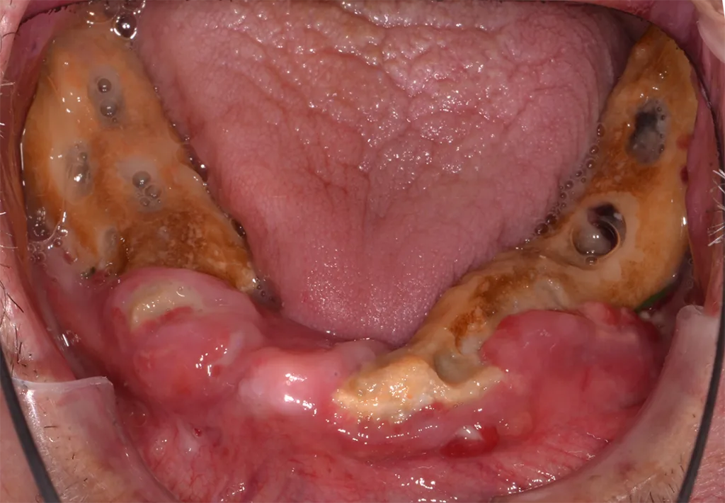 Abb. 1a und b: Ausgangssituation: Die Aufsichtsbilder zeigen den zahnlosen Ober- und Unterkiefer. Deutlich sichtbar sind die nekrotischen Knochenareale und die Entzündungen im Bereich der Gingiva.
