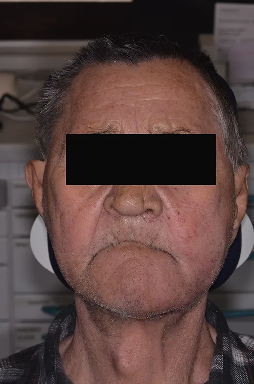 Abb. 2: Das En-face-Foto als Bestandteil eines Fotostatus zeigt den Patienten bei geschlossenem Mund und stellt die perioralen und muskulären Verhältnisse mit eingefallenem Weichgewebe dar.