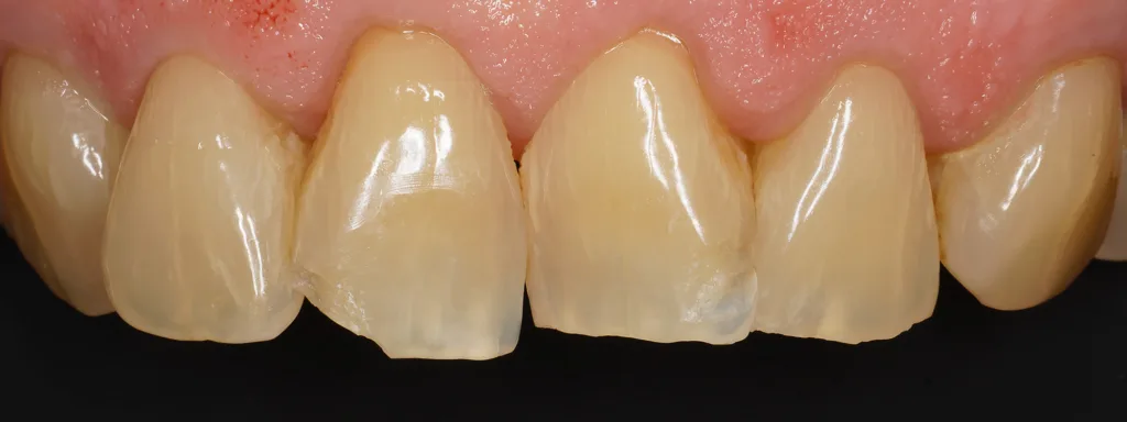 Abb. 1: Zustand nach FZT mit zwei unkomplizierten Schmelz-Dentin-Frakturen an den Zähnen 11 und 21.