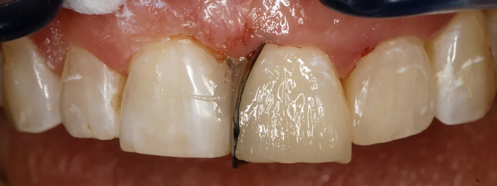 Abb. 11: Einschalung des Zahnes 21 mit einer identischen Unica Proximal anterior.
