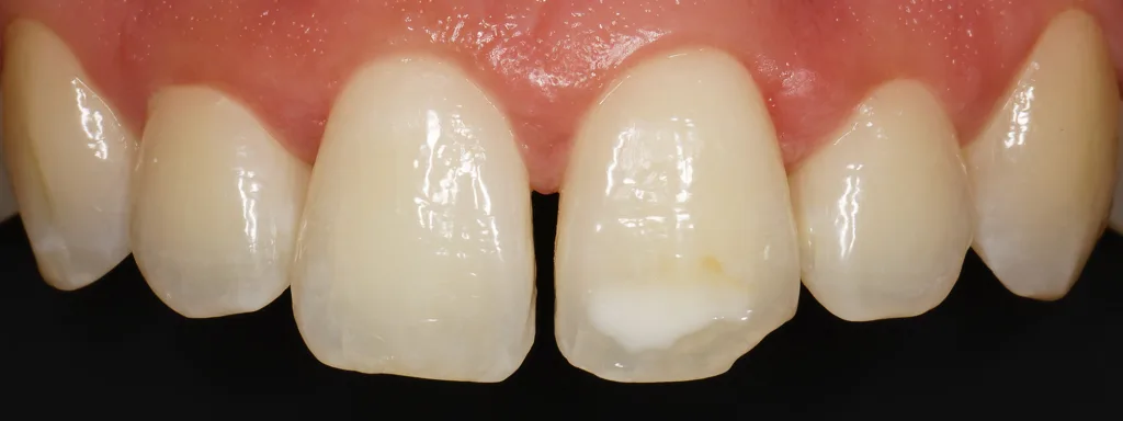Abb. 14: Störendes Diastema, ein weiß-opaker Fleck und eine bereits seit längerem abgebrochene distale Kante an Zahn 21.