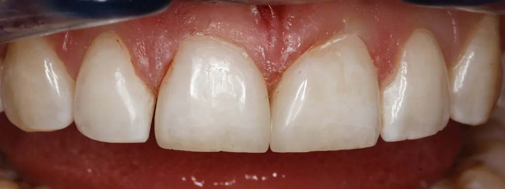 Abb. 32: Abgeschlossene Zahnverbreiterung an Zahn 11 mit separaten Anbauten mesial und distal.
