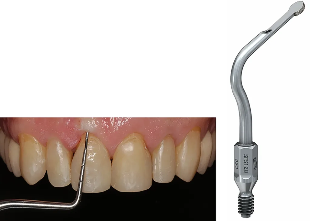 Abb. 11 a-d: Chirurgische Kronenverlängerung um 1 mm nach Schwenk/Striegel.