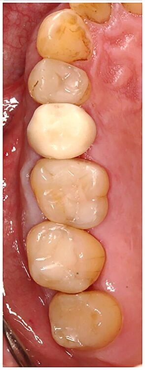 Abb. 8 a-l: EKR, Kariesexkavation, AFC, Präparation, Eierschalen- und Folienprovisorien.