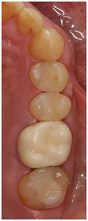 Abb. 8 a-l: EKR, Kariesexkavation, AFC, Präparation, Eierschalen- und Folienprovisorien.