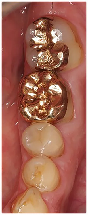 Abb. 8 a-l: EKR, Kariesexkavation, AFC, Präparation, Eierschalen- und Folienprovisorien.