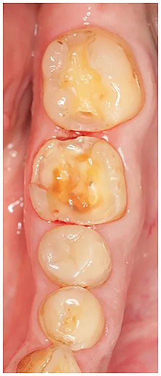 Abb. 8 a-l: EKR, Kariesexkavation, AFC, Präparation, Eierschalen- und Folienprovisorien.