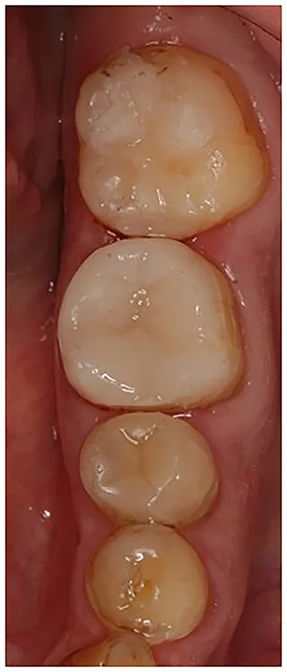 Abb. 8 a-l: EKR, Kariesexkavation, AFC, Präparation, Eierschalen- und Folienprovisorien.