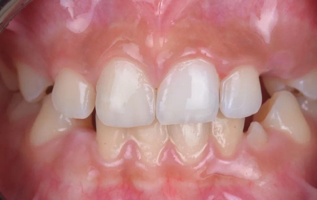 i) nach Abschluss der Behandlung und Aufbau der Inzisalkante mit Komposit. Der gezeigte Fall wurde im Rahmen einer bereits veröffentlichten Studie behandelt [17].