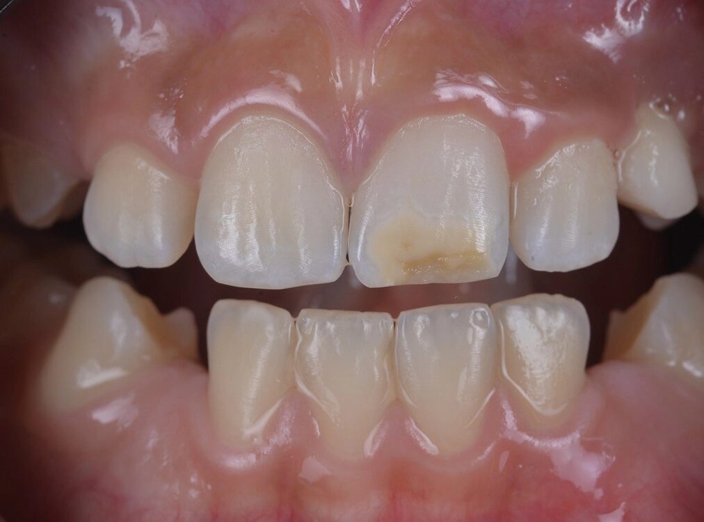 b) nach professioneller Zahnreinigung und vor Beginn des vorbereitenden Bleachings,