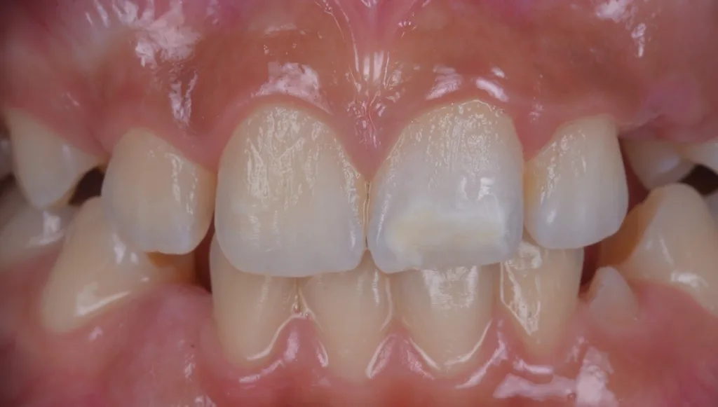 c) nach zwei Wochen täglicher Anwendung (eine Stunde/Tag),