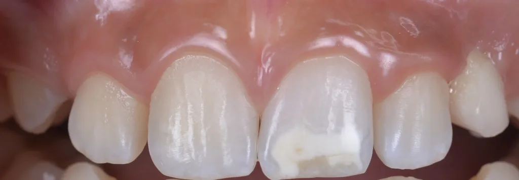 d) nach vier Wochen täglicher Anwendung (eine Stunde/Tag),