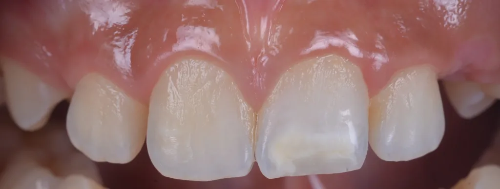 e) nach Abschluss der zweiwöchigen Wash-Out-Phase.