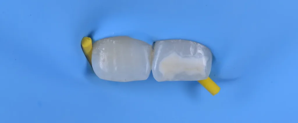 f) nach der Oberflächenkonditionierung mit Icon Etch,