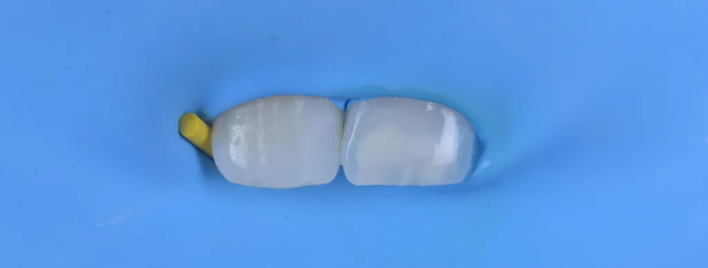 g) nach der Trocknung und Vorbereitung der Läsion mit Icon Prime,