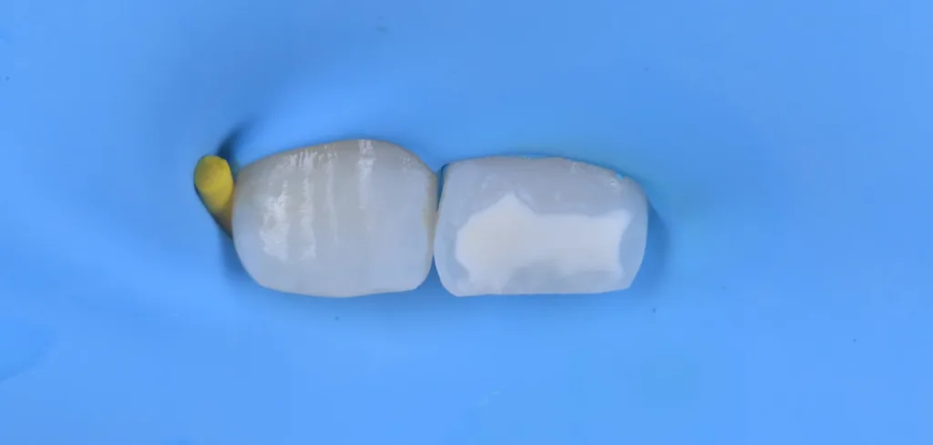 h) nach Abschluss der Infiltration und