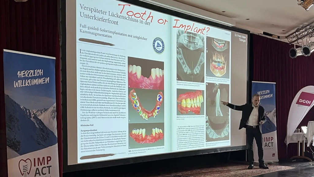Um Komplikationen beim Sinuslift und wie diese zu vermeiden sind, ging es mit Dr. Frank Maier, Tübingen. Er sensibilisierte beispielsweise für die Socket Shield Technik. 