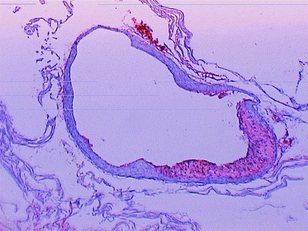 Abb. 2: Schädigung der Endothelzellschicht durch Oxidation mit Bildung von Sauerstoffradikalen (Response to Injury). Anheftung von Leukozyten mit Aufnahme von Fettverbindungen und Umwandlung in Schaumzellen. Reaktive Bindegewebsvermehrung unter Verdickung und Einengung der Gefäßwand mit Anlagerung von Gefäßplaques.