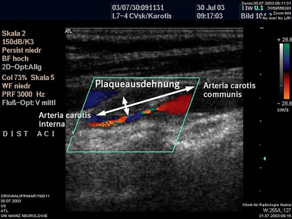 Abb. 3: Beginnende arteriosklerotische Gefäßverengung der Carotis als Folge der auf tiefere Bereiche der Arterienwand übergreifenden Entzündungsreaktion (Makroangiopathie). Foto Universität Mainz, Neurologie.